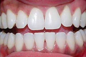 After-Zoom Whiteing Del Sur  Dentistry 92127