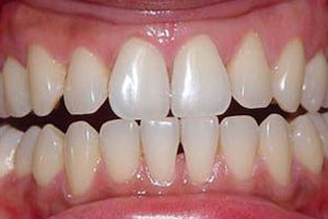 Before-Zoom Whiteing Del Sur  Dentistry 92127
